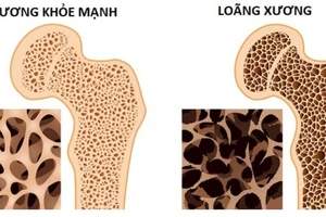 Ăn gì để đề phòng thiếu canxi?