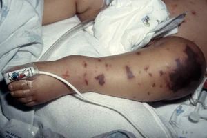 Cảnh báo nguy cơ lây lan sau ca tử vong do não mô cầu ở Phú Quốc