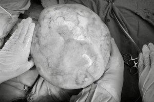 Tưởng bụng to do dậy thì, không ngờ bé gái mang khối u buồng trứng 4,3 kg