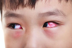 HCDC cảnh báo nguy cơ gia tăng bệnh truyền nhiễm mùa tựu trường