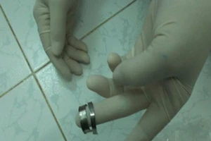 Lỡ nghịch dại đeo nhẫn, 'của quý' suýt hoại tử