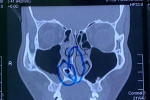 Hiếm gặp: Sỏi to bằng viên bi nằm trong hốc mũi