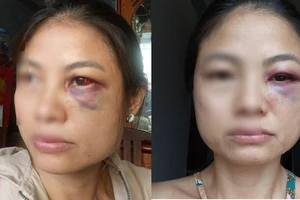 Người phụ nữ ở Đồng Nai cầu cứu vì liên tục bị chồng bạo hành