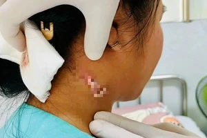 Sức khỏe bé gái 14 tuổi bị nhiễm vi khuẩn 'ăn thịt người' ở Đồng Nai
