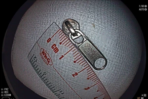 Bé trai 6 tuổi nuốt đầu khóa kéo vào dạ dày