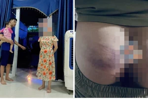 Làm rõ vụ học sinh bị cô giáo đánh nghi do làm nhầm bài tập