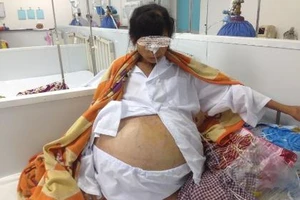 Mổ lấy khối u 12 kg trong bụng nữ bệnh nhân