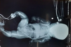 Em bé vừa sinh ra đã nghi mắc bệnh xương thủy tinh