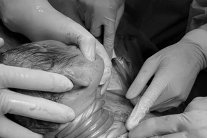 Cần Thơ: Cấp cứu kịp thời trường hợp suy thai cấp do dây rốn quấn cổ 5 vòng