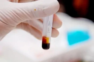 Viêm gan A là gì và có nguy hiểm không?