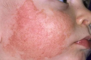 Bệnh chàm có chữa dứt điểm?