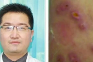 Gắp 20 con giòi sống ra khỏi cơ thể