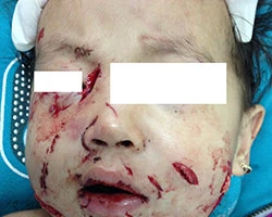 Tội nghiệp bé gái bị chó cắn rách mặt