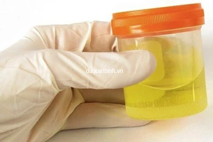 Đoán bệnh qua màu nước tiểu