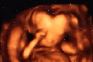 Cậu bé có đầu hình trái tim khi siêu âm 3D 
