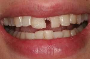 Răng tự nhiên bị mẻ là bị bệnh gì?