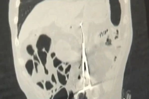 Bỏ quên kéo 20cm trong bụng bệnh nhân 12 năm