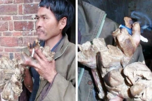 Bệnh lạ: Chân tay tự nhiên biến thành... củi khô