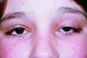 Dấu hiệu sớm của bệnh sa mí mắt