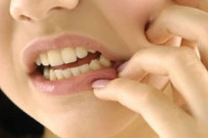 Tất cả những điều bạn cần biết về răng khôn