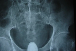 Cụ ông 85 tuổi mang trong mình viên sỏi 1kg