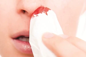 Đừng coi thường chảy máu mũi