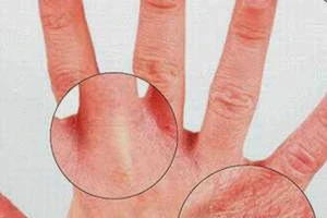 Những điều cần biết về viêm da cơ địa