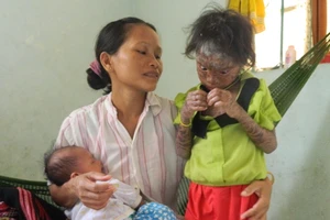 Bé 9 tuổi bị bệnh vảy cá hiếm gặp