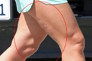 Những điều cần biết về tích mỡ dưới da