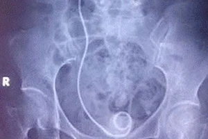 Bỏ quên 'vật lạ' trong cơ thể hàng chục bệnh nhân suốt 10 năm