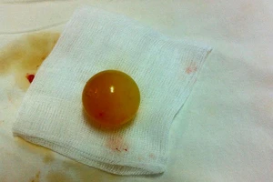 Trẻ tắc ruột do nuốt hạt đồ chơi