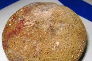 Viên sỏi thận to bằng quả cam trong cơ thể người đàn ông