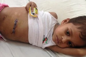 Lấy búi tóc dài 1,2m trong dạ dày bé trai 4 tuổi