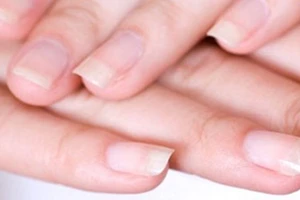 Móng tay bị mủn là bệnh gì?