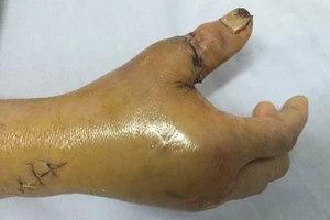 Nối thành công ngón tay cái đứt lìa, rút gân 20 cm