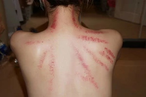 Những sai lầm nguy hiểm khi cạo gió