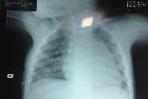 Bé 3 tuổi bị thủng phổi vì kim đâm xuyên ngực