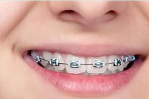 Cách giảm đau buốt sau khi niềng răng