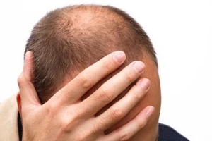 Hói đầu và ung thư tuyến tiền liệt: Có liên quan!