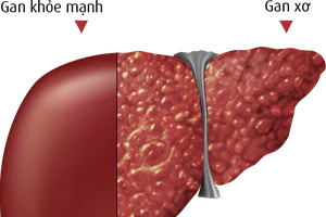 Không cần sinh thiết gan vẫn biết được bị xơ gan