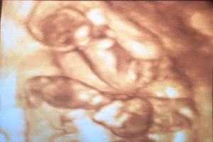 Một phụ nữ Quảng Bình mang thai tự nhiên 4 em bé