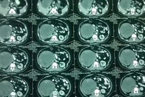 Đến viện khám ho, phát hiện u thận nặng 5 kg