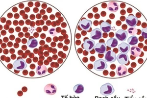Ai dễ mắc ung thư máu?