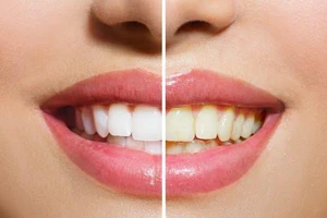 13 nguyên do gây vàng răng mà bạn không thể ngờ