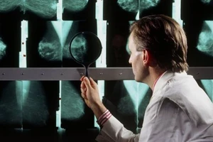 Progesterone có thể làm giảm ung thư vú