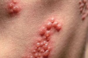 Bệnh giời leo có phải là bệnh zona thần kinh?