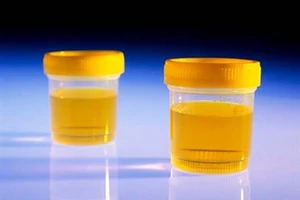 Xét nghiệm nước tiểu có thể phát hiện ung thư