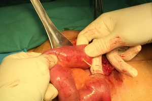  Nuốt tăm tre, bị đâm thủng ruột mà không hay biết