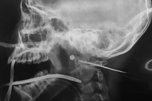 Ngồi trong nhà, bé gái ‘dính’ đạn lạc xuyên cổ