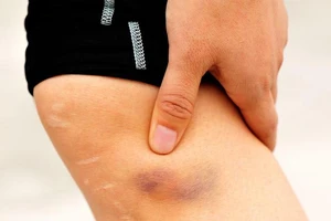 Cách chữa nhanh vết bầm tím trên da